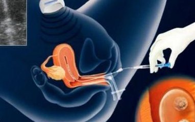 衢州市妇幼保健院做三代试管婴儿的成功率有多少？附试管助孕详细费用汇总